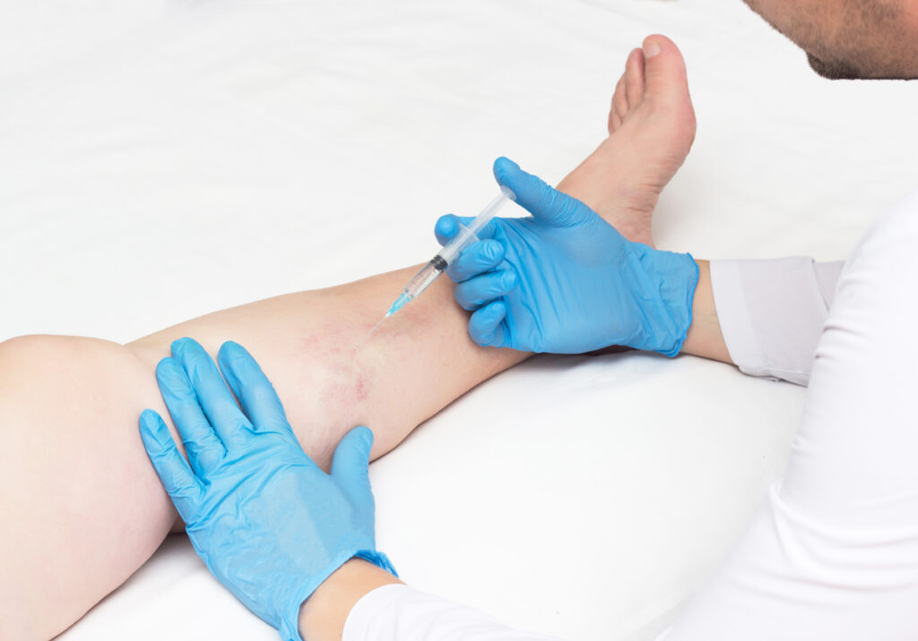 Are you looking for a vein doctor to treat your varicose veins or other venous disorders? If so, it is important to consider the qualities of a good varicose vein treatment clinic near me in SD. In this article, we discuss how to find the best varicose vein treatment clinic for your treatment.