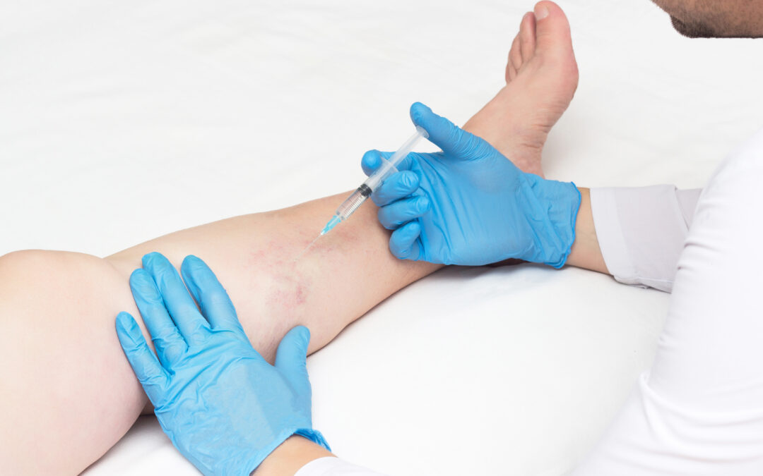 Vein Treatment Clinic is widely considered the best vein clinic in California. This article provides a detailed overview of our uniquely comprehensive varicose vein treatment process.