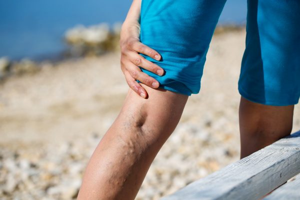 What treatment options can I seek for my spider veins and venous insufficiency from a vein doctor near me California? We break down the process step-by-step from when you first identify spider veins or varicose veins, until you undergo treatment from a vein doctor.