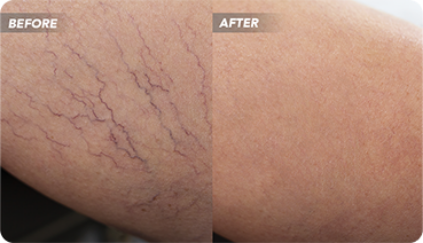 What is the treatment process for spider veins and venous insufficiency at a spider vein treatment clinic near me California? We walk you through the steps of vein treatment from the moment you start seeing spider veins until you undergo treatment from a vein doctor. 