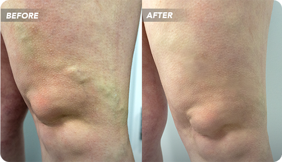 VTCBefore-After-3