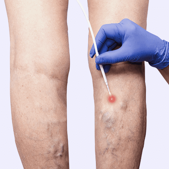 ENDOVENOUS