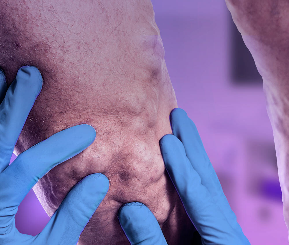veinclinics_heromobile_vein-disease_varicosevein