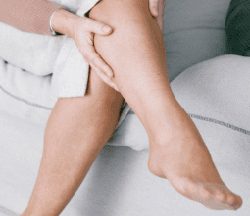 Woman's legs with vein problems - Vein Clinic