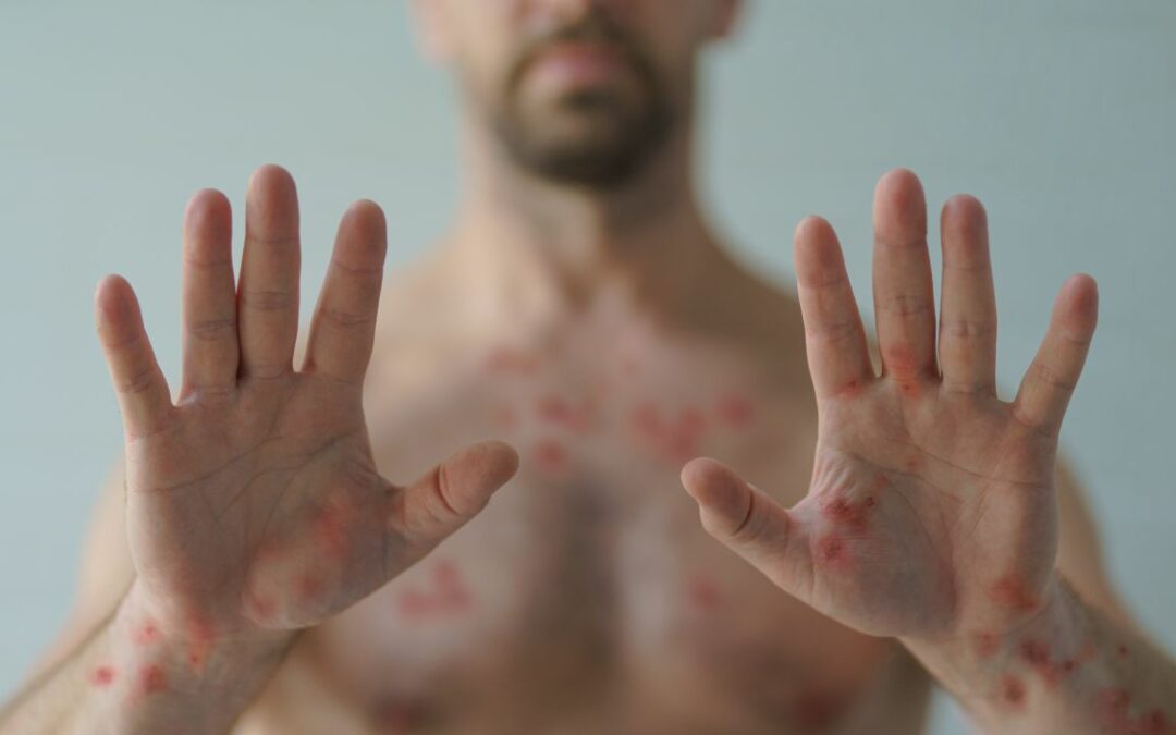 Can Monkeypox affect your veins? What you need to know!